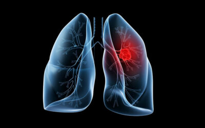 Multinational Lung Cancer Diagnosis & Control Project in Ethiopia