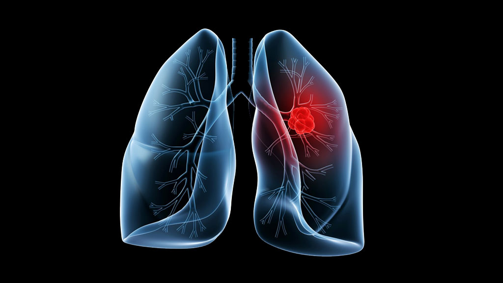 Multinational Lung Cancer Diagnosis & Control Project in Ethiopia